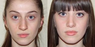 voor en na plasma huidverjonging